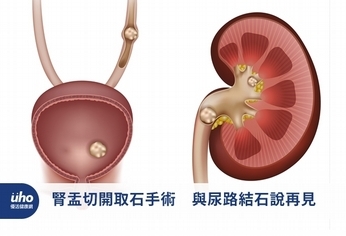 腎盂切開取石手術　與尿路結石說再見