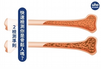 2檢測準則 快速檢測你是骨鬆人嗎?