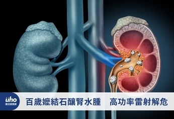 百歲嬤結石釀腎水腫　高功率雷射解危