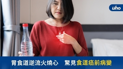 胃食道逆流火燒心 驚見食道癌前病變
