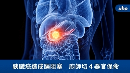 胰臟癌造成腸阻塞 廚師切4器官保命