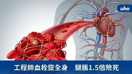 工程師血栓竄全身　腿脹1.5倍險死