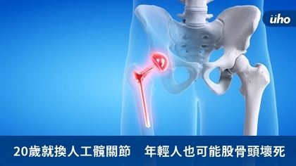20歲就換人工髖關節 年輕人也可能股骨頭壞死