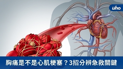 胸痛是不是心肌梗塞？3招分辨急救關鍵