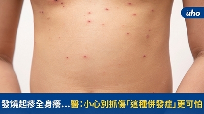 發燒起疹全身癢⋯醫:小心別抓傷「這種併發症」更可怕